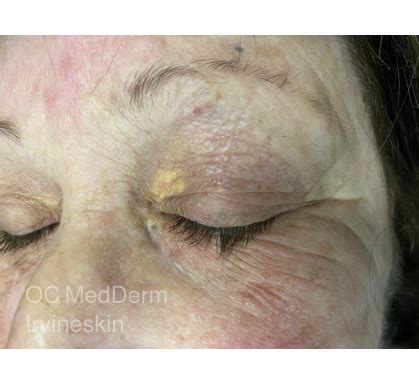 Xanthelasma Gallery - Irvineskin