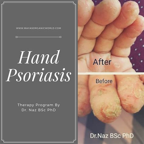 Hand Psoriasis | Maya's Organic World