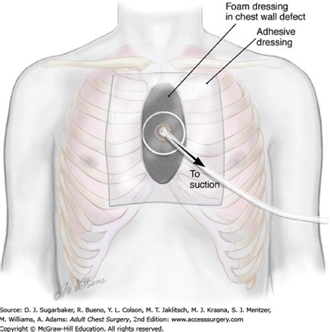 Chest Wall Resection and Reconstruction | Thoracic Key