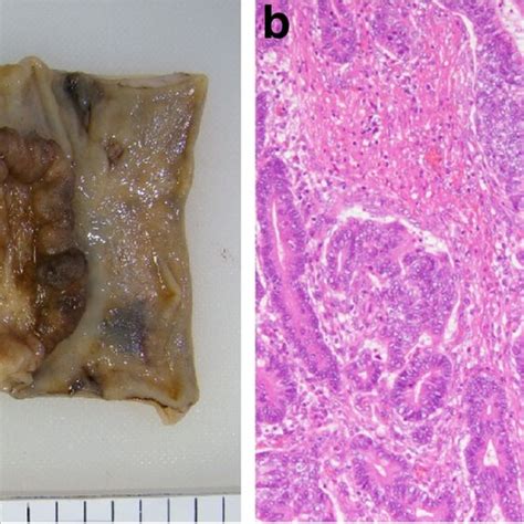 Specimen And Pathological Findings In The Initial Surgery Curative