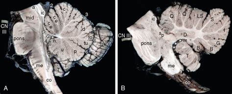 Cerebellar Vermis Sagittal View