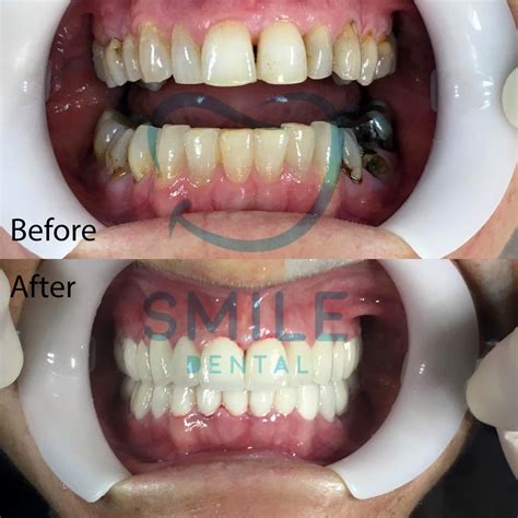 Turkey Teeth Before After Veneers Before After