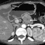 Pancreatic ductal adenocarcinomas. Axial ( ) and precontrast ...