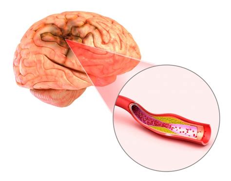 S Ntomas Y Causas De Una Embolia Cerebral Salud