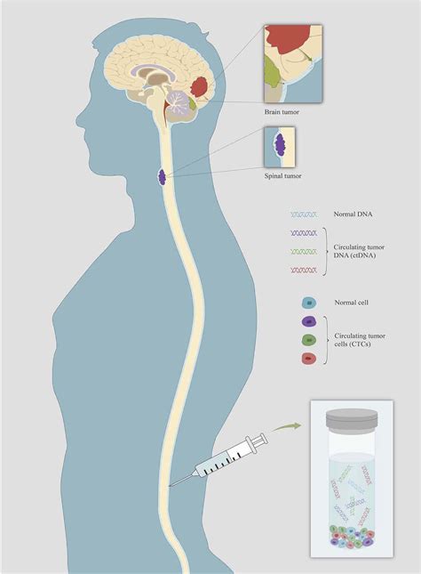 Figure From Clinical Applications Of Cerebrospinal Fluid Circulating