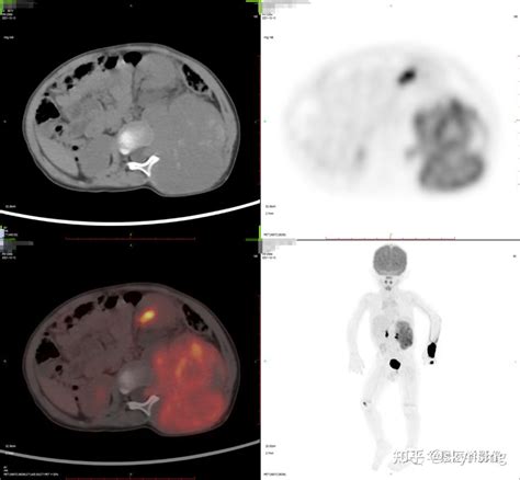 一文通读解析pet Ct检查所有注意事项、放射性危害及典型教学病例一例 知乎