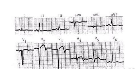 心電圖下﻿心肌梗死的定位診斷 每日頭條