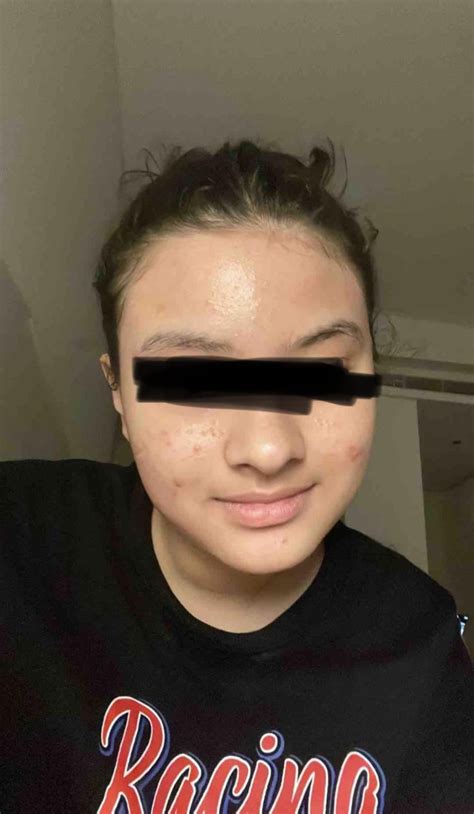 8 Months Tretinoin Results Before And After R Tretinoin