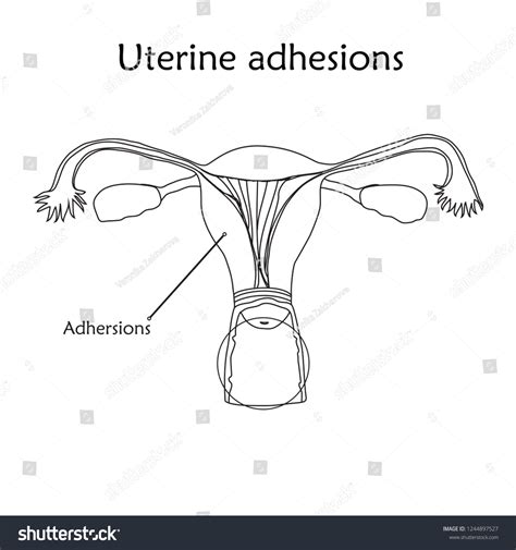 Uterine Adhesions Human Realistic Uterus Anatomy Stock Vector Royalty