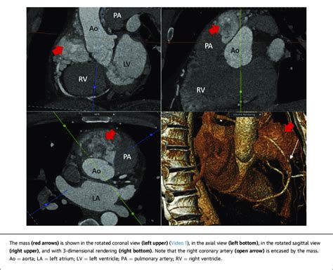 Computed Tomography Angiography Of The Chest Showing The Paraganglioma