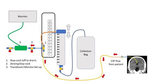 Anatomy Of An External Ventricular Drain Criticalcarenow