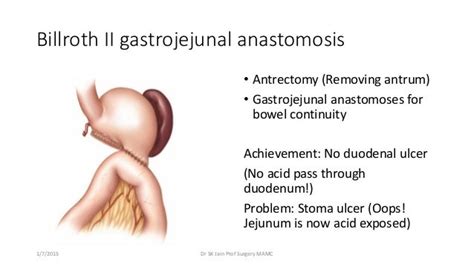 Peptic ulcer disease