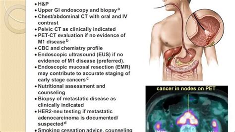 Gastric Cancer Video Youtube