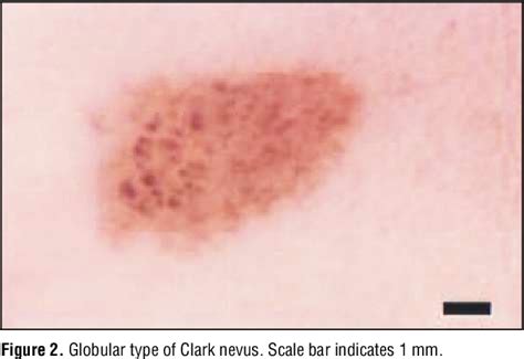 Figure 2 From Dermoscopic Classification Of Atypical Melanocytic Nevi