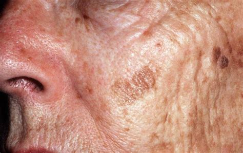 Age Spots - Causes, How To Get Rid, Cream & Treatment