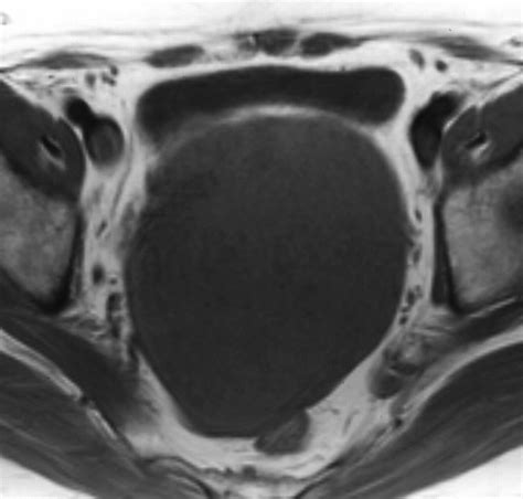 CT And MRI Findings Of Sex CordStromal Tumor Of The Ovary AJR