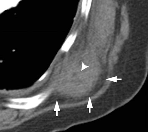 Elastofibroma Dorsi Radiographics