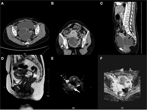 Computed Tomography Showing The Irregular Shape Of Uterus A There Is