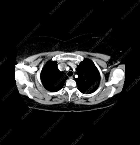 Necrotic Lymph Node Ultrasound