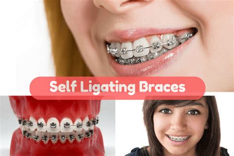 Self Ligating Braces, Pros, Cons, Cost, Brands, Ceramic type