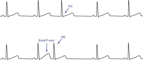 pjc-pac - Cardiac Sciences Manitoba