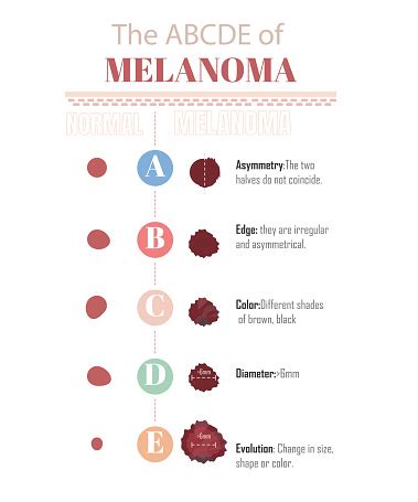 The Abcde Of Melanoma Stock Illustration - Download Image Now ...