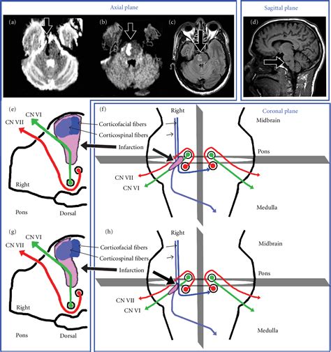 Figure From A Case Of Classic Raymond Syndrome Semantic Scholar