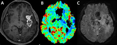 An Example Of An Uninterpretable Dsc Perfusion Mr Image Images