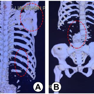 Three Dimensional Reconstruction Of Ct Scans In Local Hospital