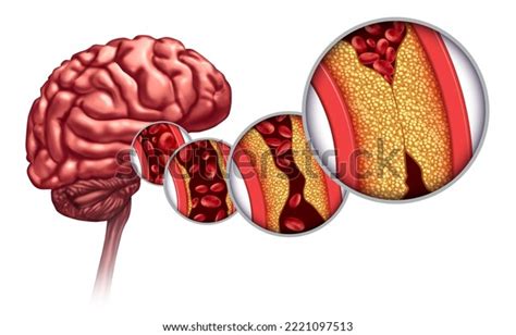 Atherosclerosis Stroke Brain Disorder Caused By Stock Illustration ...