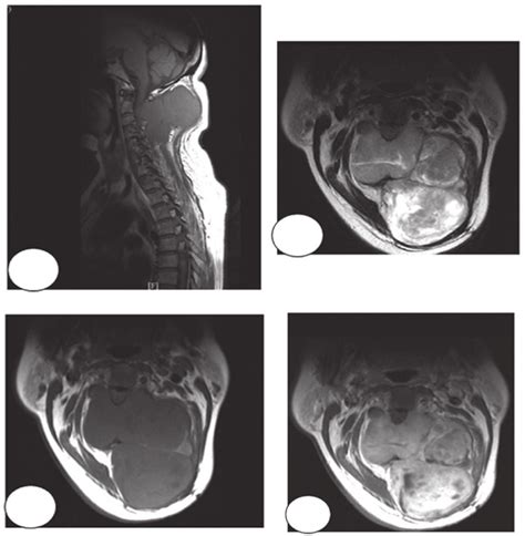 A Year Old Female With Synovial Sarcoma A Magnetic Resonance