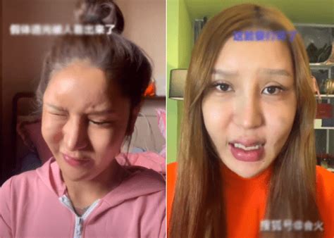 Hot girl nổi tiếng công khai ảnh phẫu thuật hỏng lõm cả trán khuôn mặt biến dạng