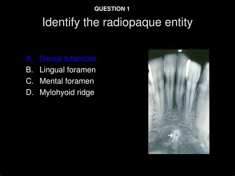 Genial Tubercle X Ray