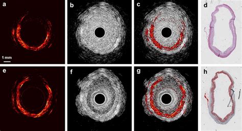 In Vivo Intravascular Ultrasound Guided Photoacoustic Imaging Of Lipid