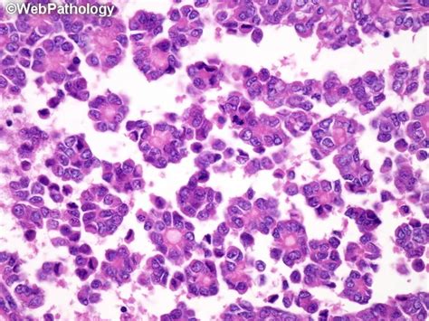 Clear Cell Sarcoma Like Tumor Of Gi Tract