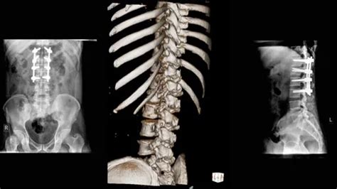 CT Scan Thoracic Spine Ct With 3D Recons Stock Video Pond5