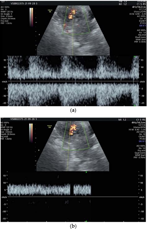 Figure 3 From Retained Placenta Percreta With Acquired Uterine Arteriovenous Malformation—case