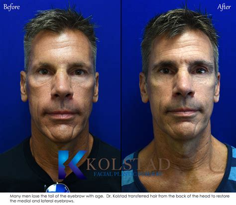 Eyebrow Transplant San Diego 48 Kolstad Hair Restoration