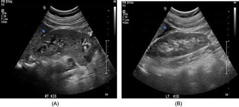 Distinguishing Between Cornual Angular And Interstitial Ectopic