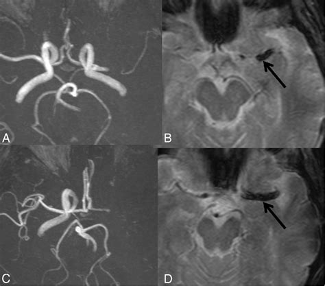 Figure From Susceptibility Vessel Sign On Mri Predicts Favorable