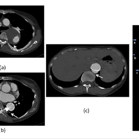 Ct Aortogram With Contrast Showing Type A Aortic Dissection A Coronal