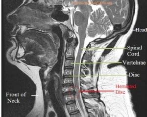 cervical disk mri | Anatomy System - Human Body Anatomy diagram and ...