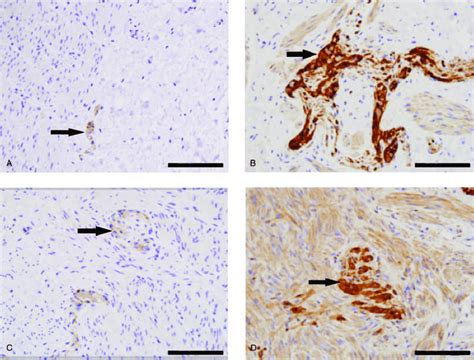 Immunohistochemical Staining Of Neuron Specific Enolase Nse Between