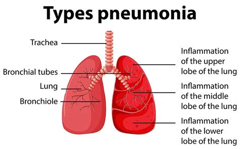 Pneumonia In Elderly: Causes, Prevention & Treatments - Aston Gardens