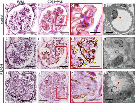 Alteration Of The Glomerular Capillary Network By Endocapillary