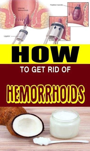 Pin On Hemorrhoid Remedies