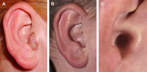 Pyogenic Granuloma Treatment By Shave Excision And Or Pulsed Dye Laser