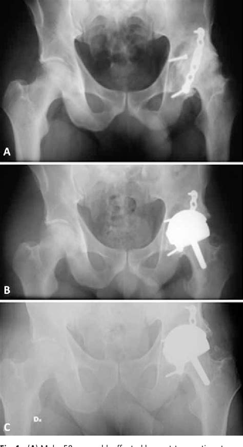 Figure From Clinical And Radiographic Outcomes Of The Birmingham Hip