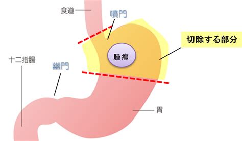 胃がんの手術について 国立がん研究センター 東病院