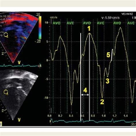 A Lateral Mitral Annular Real Time Pulsed Tissue Doppler Showing